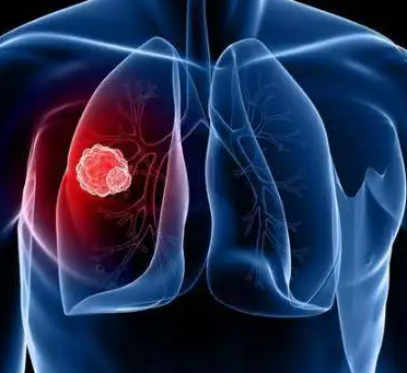 肺癌基因突变是什么意思？非小细胞肺癌基因突变有哪些类型？【临床试验知识】